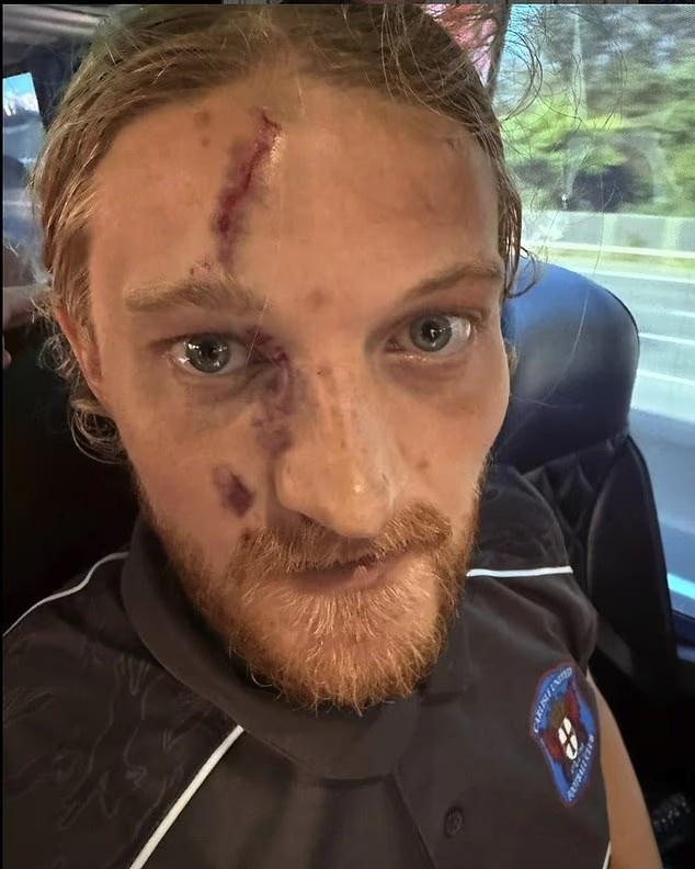 在一次禁区, 后者鞋钉划, 布了伤势详 在一次禁区, 后者鞋钉划, 布了伤势详